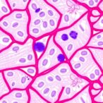 targeting-s100a4–tlr4–tgf-β-axis-in-diabetic-dupuytren’s