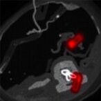 deep-medullary-vein-thrombosis-in-newborns-study