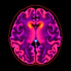 gaba-dysfunction-in-parkinson’s-revealed-by-mri