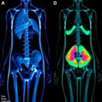 pet-imaging-reveals-whole-body-metabolic-shifts-following-bariatric-surgery