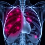 ai-revolutionizes-early-detection-of-breast-cancer-in-high-risk-women