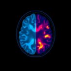 mri-endpoints-redefined-for-ataxia-clinical-trials