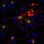 neurofilament-light,-gfap:-biomarkers-for-postoperative-delirium