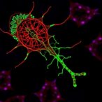 tumor-promoting-role-of-msx1-in-cervical-cancer