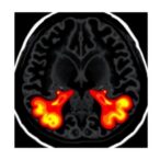prostate-mri-enhances-biopsy-accuracy-and-outcomes