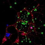 single-cell-sequencing-uncovers-burkitt-lymphoma-evolution