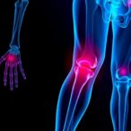 dual-amylin-calcitonin-agonists:-osteoarthritis-game-changers