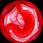 long-term-outcomes-of-endoscopic-resection-in-gastric-adenocarcinoma
