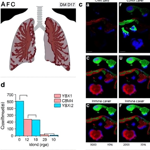 ybx1-drives-immune-evasion-in-lung-cancer-bone-metastases