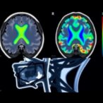 enhancing-cns-tumor-therapy-with-mri-guided-ultrasound