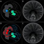 tracing-metastasis-and-evolution-in-uveal-melanoma