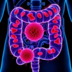 new-study-reveals-mechanisms-behind-high-iron-levels-in-colorectal-cancer-cells