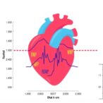 lad/bsa,-nt-probnp-predict-pediatric-heart-death
