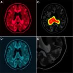 intraventricular-hemorrhage-rates-and-predictors-compared