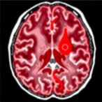 inflammation-resolution-failure-in-intracerebral-hemorrhage