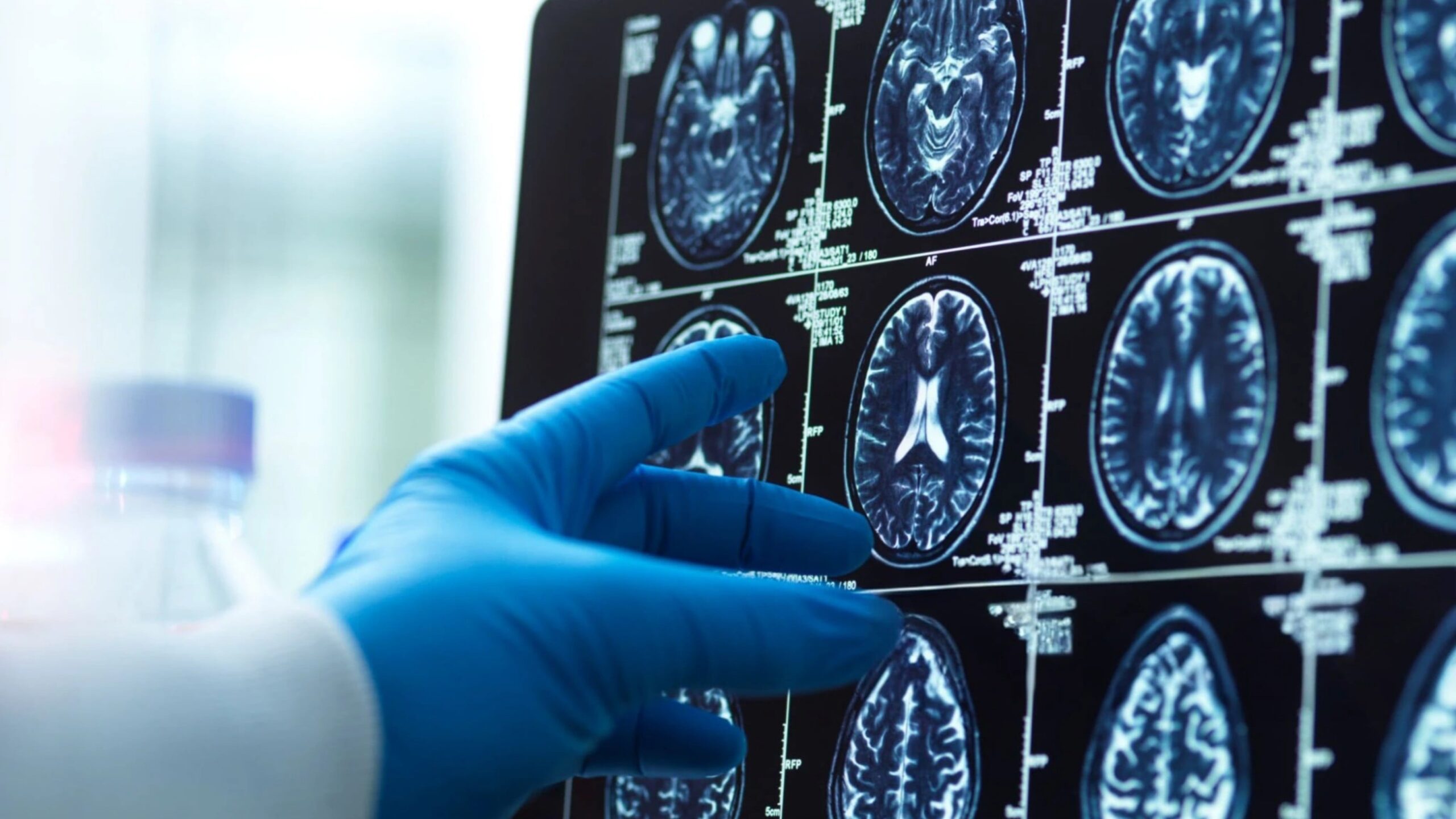 abbott-pens-blood-based-alzheimer’s-testing-pact-with-alzpath