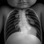alveolar-capillary-dysplasia-in-neonates:-multicenter-study
