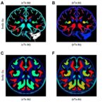 personalized-neoantigen-dendritic-cell-vaccine-in-glioblastoma