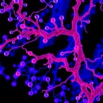 proteomic-analysis-identifies-prognostic-subgroups-in-smarca-deficient-esophageal-cancer