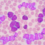 epigenomic-analysis-uncovers-new-aml-subgroups-and-drug-sensitivities