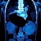 second-psma-pet-scan-alters-treatment-in-almost-half-of-prostate-cancer-cases