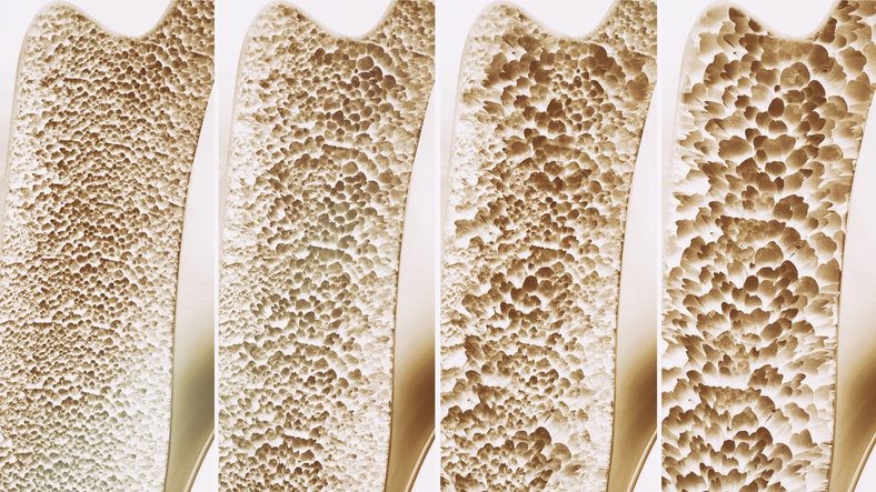 genetic-map-opens-door-to-development-of-new-therapies-to-reverse-bone-loss