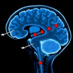 deep-learning-detects-rem-sleep-disorder-and-parkinson’s-early-via-fmri