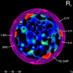 mapping-tumor-microenvironment-immune-pathways-in-immunotherapy-treated-melanoma