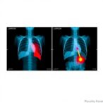 blood-test-model-predicts-postoperative-lung-infections-in-older-hip-fracture-patients
