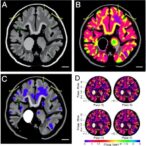 metabolomic-profiling-reveals-subtype-specific-molecular-programs-in-pediatric-ependymoma