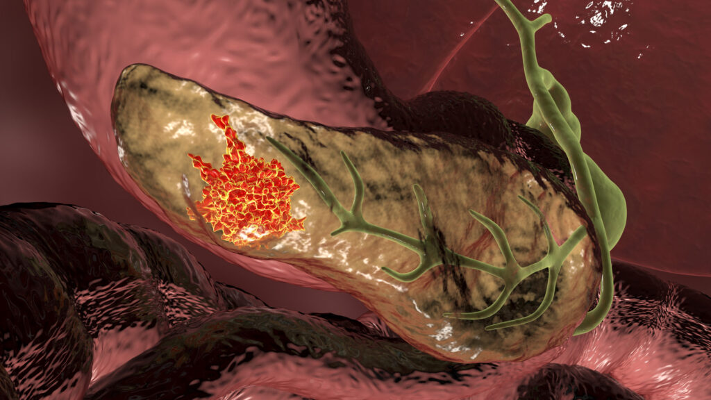 kras-targeted-vaccine-crosses-first-clinical-milestone-in-pancreatic-cancer-prevention