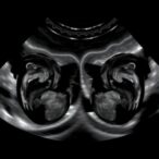 delayed-vs-early-cord-clamping-in-preterm-twins:-echocardiography-study