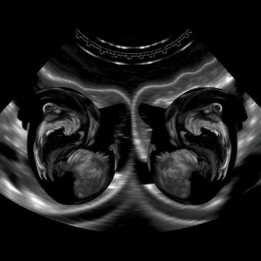 delayed-vs-early-cord-clamping-in-preterm-twins:-echocardiography-study