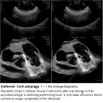 echocardiography-markers-after-deferred-cord-clamping-with-varying-oxygen-levels