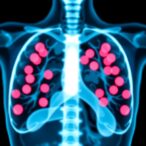 preoperative-dual-immunotherapy-shows-promise-in-high-risk-early-her2-negative-breast-cancer