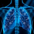 targeted-treatments-aim-to-improve-outcomes-for-serious-lung-infections
