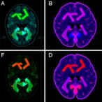 new-neonatal-hypoxic-ischemic-model-shows-glial-activation,-memory-deficits-without-neuronal-loss