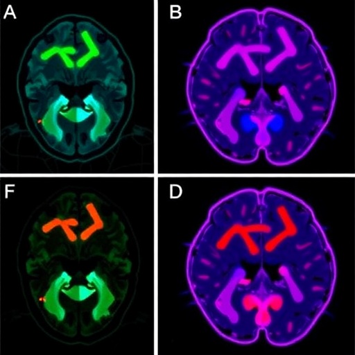new-neonatal-hypoxic-ischemic-model-shows-glial-activation,-memory-deficits-without-neuronal-loss