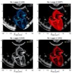 early-nt-probnp-versus-echocardiographic-plase-score-for-predicting-pda-surgery