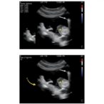 ultrasound-guided-nasojejunal-tube-placement-reduces-malposition-and-radiation-in-newborns