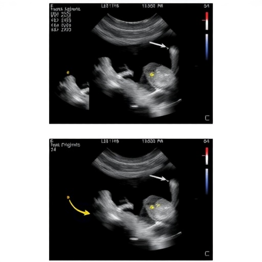 ultrasound-guided-nasojejunal-tube-placement-reduces-malposition-and-radiation-in-newborns