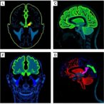 study-profiles-gcase-activity-and-α-synuclein-proteoforms-in-parkinson’s-disease-brains