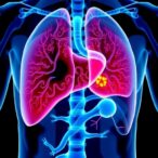 early-us-clinical-results-show-histotripsy-treating-liver-tumors