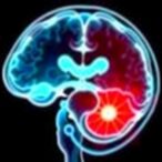 radiopharmaceutical-could-benefit-metastatic-prostate-cancer-patients-sooner