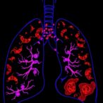 study-explores-pdlim2-as-prognostic-biomarker-and-treatment-target-in-lung-adenocarcinoma