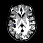 ai-framework-unifies-mri-tumor-segmentation,-grading,-staging,-and-malignancy-detection