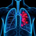 molecular-residual-disease-testing-guides-care-after-egfr-mutated-lung-cancer-surgery