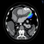 ai-foundation-model-stratifies-and-triages-acute-abdominal-diagnoses-using-noncontrast-ct