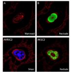 akr1c2-drives-cervical-cancer-lymph-node-metastasis-through-noncanonical-nuclear-activity