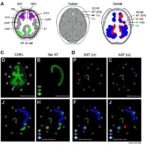 bispecific-car-t-cells-eliminate-achr-specific-b-cells-in-myasthenia-gravis-models